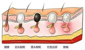 女生如何去除脸上的痘痘