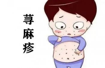 丘疹样荨麻疹怎么治疗