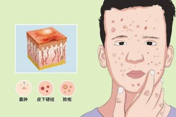 究竟青春痘能不能挤